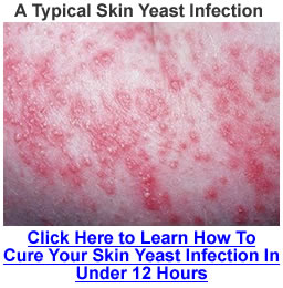 skin yeast infections #11